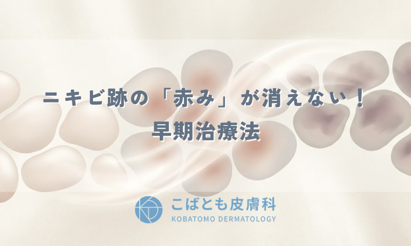 ニキビ跡の「赤み」がいつまでも消えない！茶色いシミ・紫色になる前の早期治療法