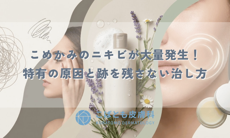 こめかみのニキビが大量発生！ストレス？シャンプー？特有の原因と跡を残さない治し方