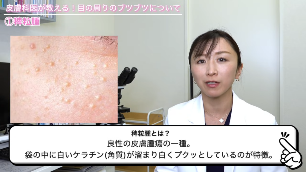 稗粒腫の見た目