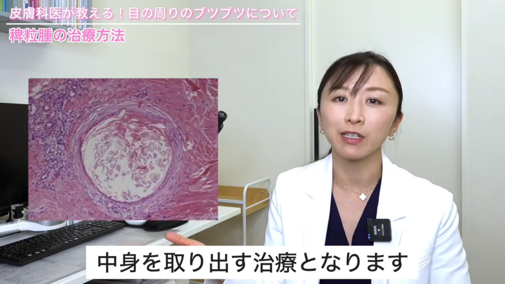 稗粒腫の治療法