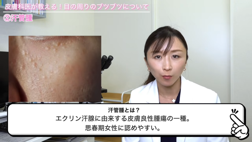 汗管腫の見た目