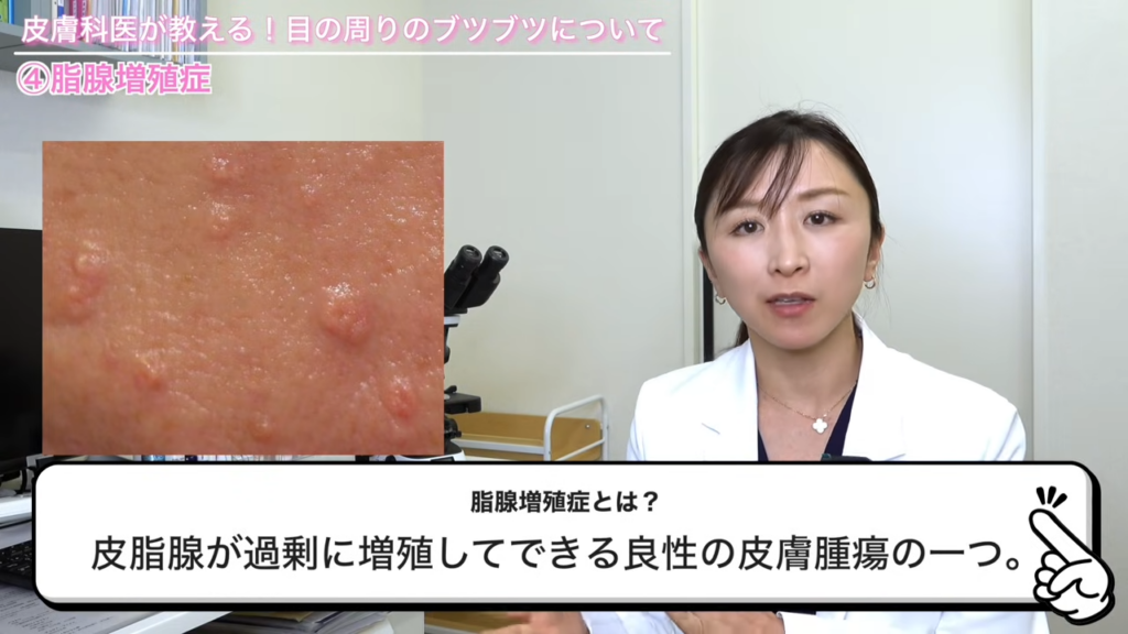 脂腺増殖症の見た目