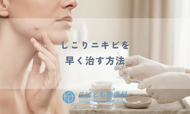 しこりニキビを早く治す方法｜皮膚科での治療・処方薬と絶対NGなケア