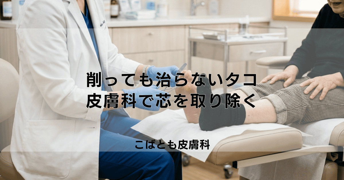 自分で削っても治らない「タコ」は皮膚科へ|芯を取り除く正しい治療法