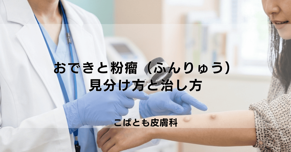 「おでき」と「粉瘤（ふんりゅう）」の違いとは？見分け方とそれぞれの治し方