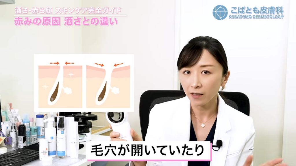 酒さ：ダーモスコピーの所見としては毛穴が開いていたり、毛穴周りに赤みを強く認めるのが特徴