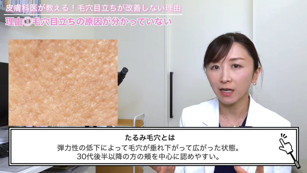 たるみ毛穴とは