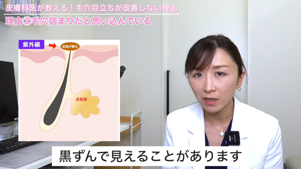 皮脂フィラメントの出口のところが、紫外線などによって皮脂が酸化されると少し茶色っぽくなって黒ずんで見えることがある