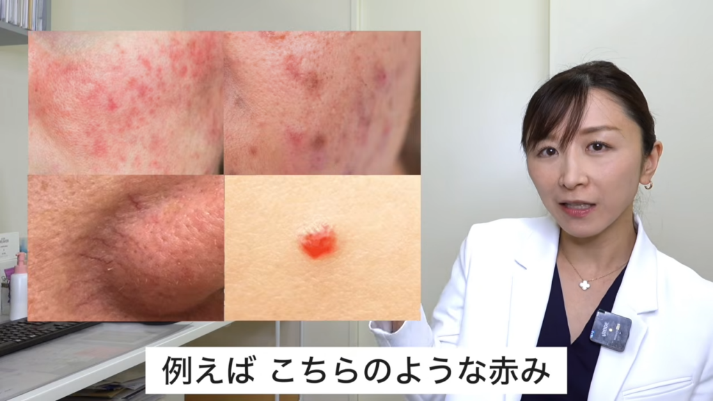 Vビームが適応になる「赤み」の例