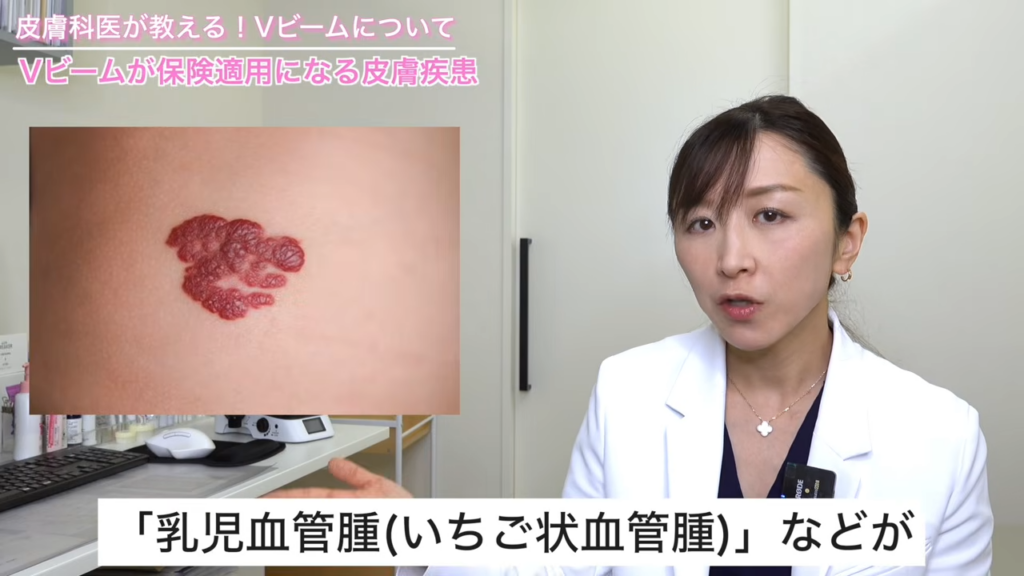 乳児血管腫(いちご状血管腫)