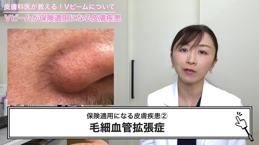 毛細血管拡張症