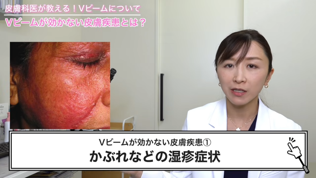 かぶれなどの湿疹症状