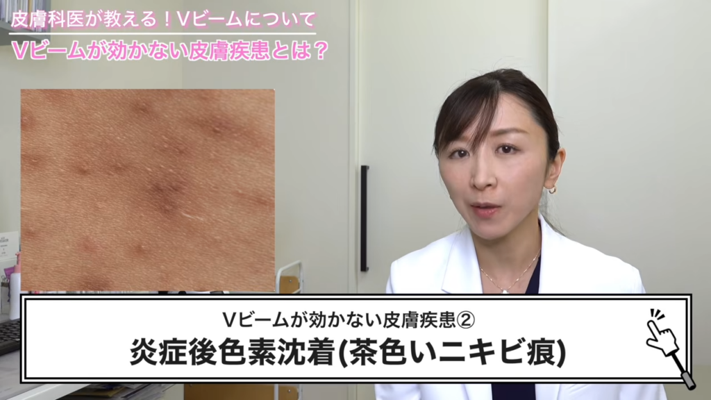 炎症後色素沈着(茶色いニキビ跡)