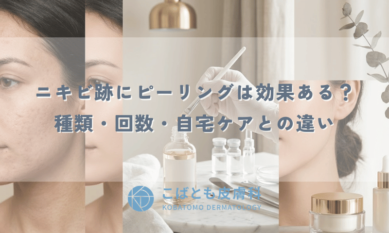 ニキビ跡にピーリングは効果ある？種類・回数・自宅ケアとの違い
