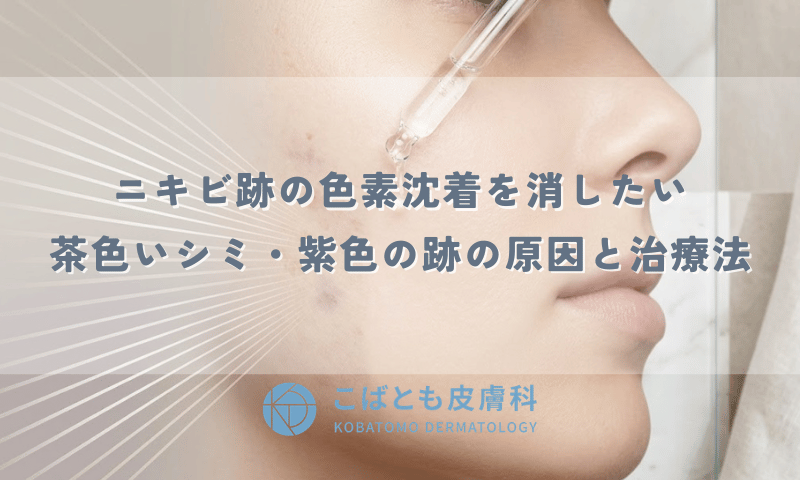 ニキビ跡の色素沈着を消したい｜茶色いシミ・紫色の跡の原因と治療法
