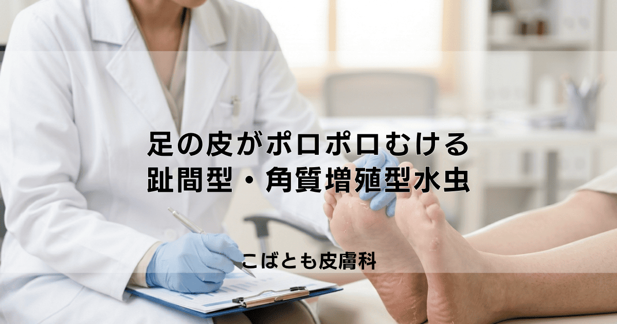 足の皮がポロポロむける…それ水虫かも？趾間型・角質増殖型水虫の治し方