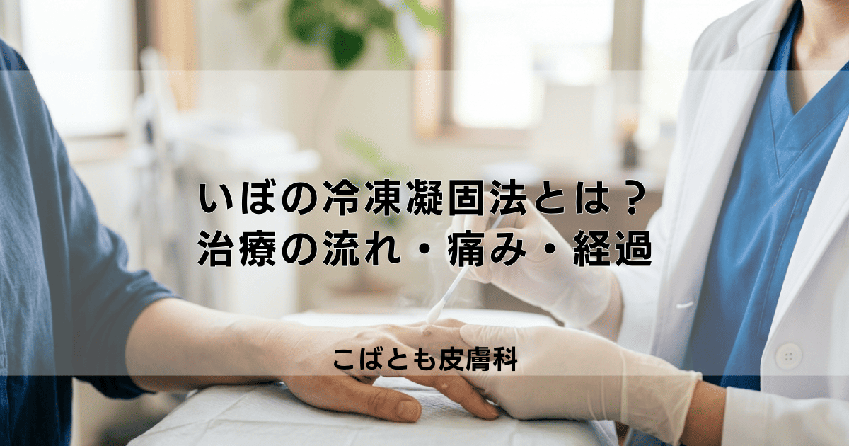 いぼの冷凍凝固法とは？治療の流れ・痛み・治療後の経過について解説