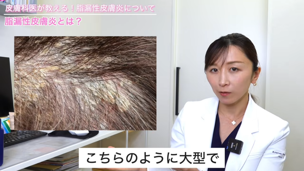 脂漏性皮膚炎のフケの特徴