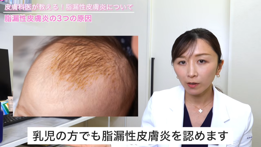 乳児の脂漏性皮膚炎
