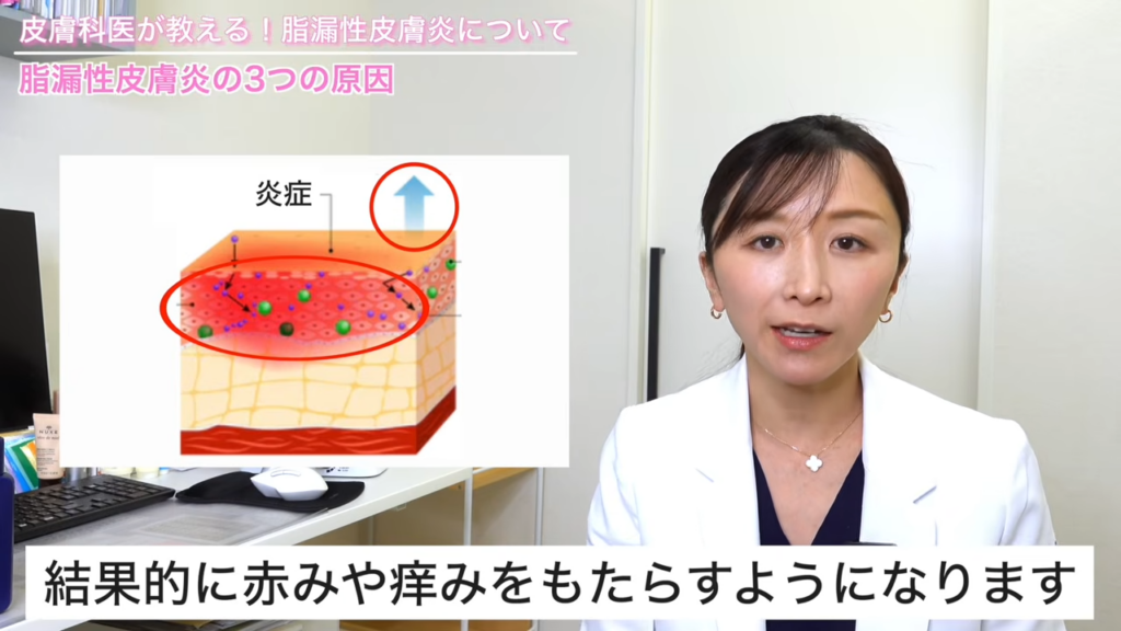 脂漏性皮膚炎を発症する仕組み