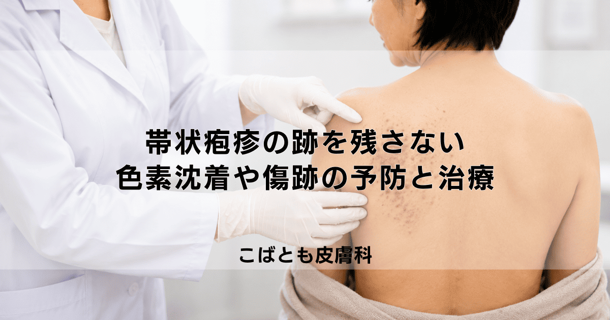 帯状疱疹の跡を残さないためには？色素沈着や傷跡の予防と治療法