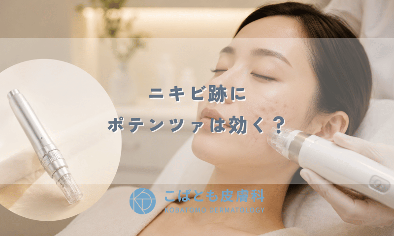 ニキビ跡にポテンツァは効く？効果・回数・費用とダーマペンとの違い