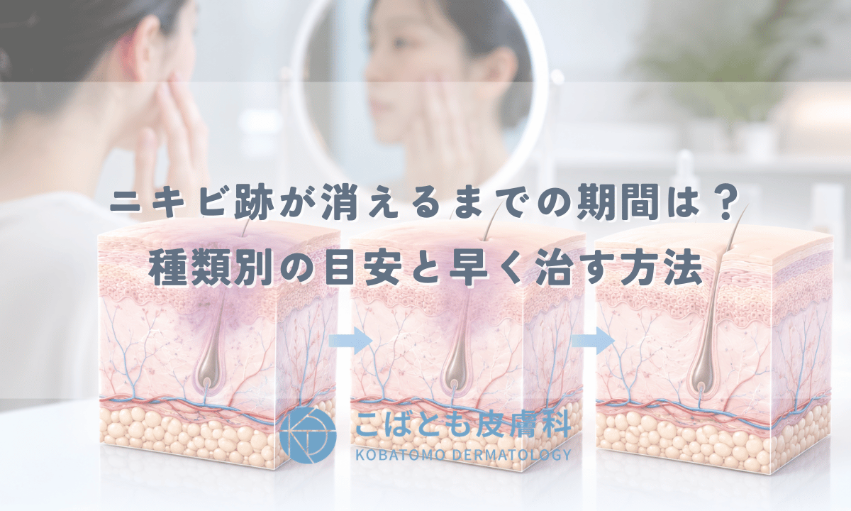 ニキビ跡が消えるまでの期間は？種類別の目安と早く治すためにできること