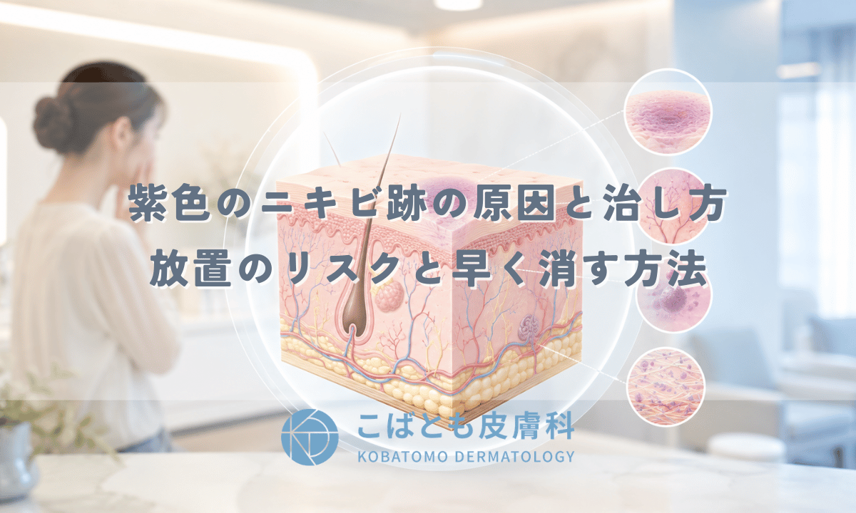 紫色のニキビ跡（内出血）の原因と治し方｜放置のリスクと早く消す方法
