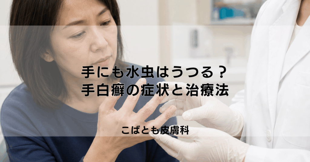 手にも水虫はうつる？手の指にできる「手白癬（てはくせん）」の症状と治療法