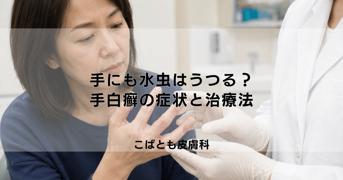 手にも水虫はうつる？手の指にできる「手白癬（てはくせん）」の症状と治療法