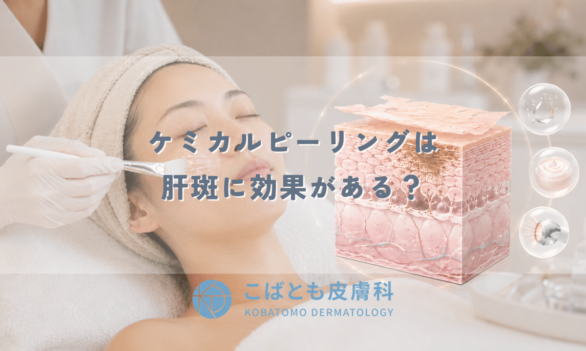 ケミカルピーリングは肝斑に効果がある?単独では不十分な理由と併用治療を皮膚科医が解説