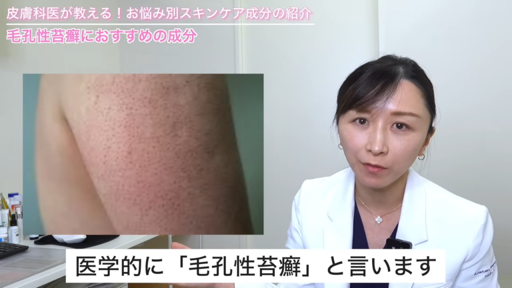 毛孔性苔癬 症状写真