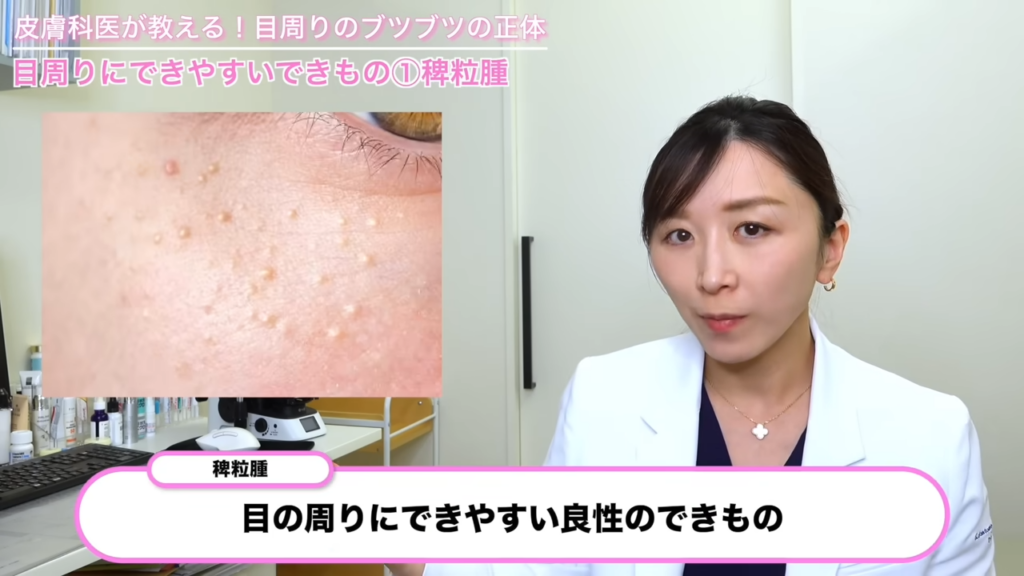 稗粒腫 症例写真