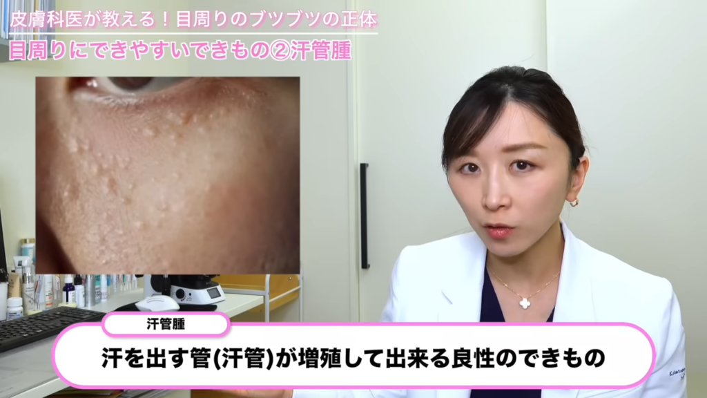 汗管腫 症例写真
