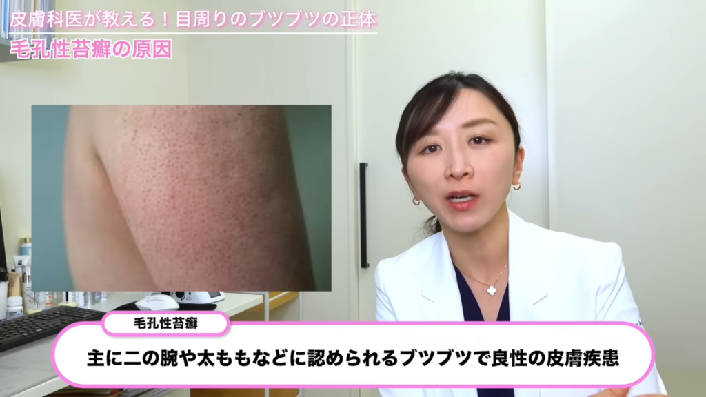 毛孔性苔癬 症例写真