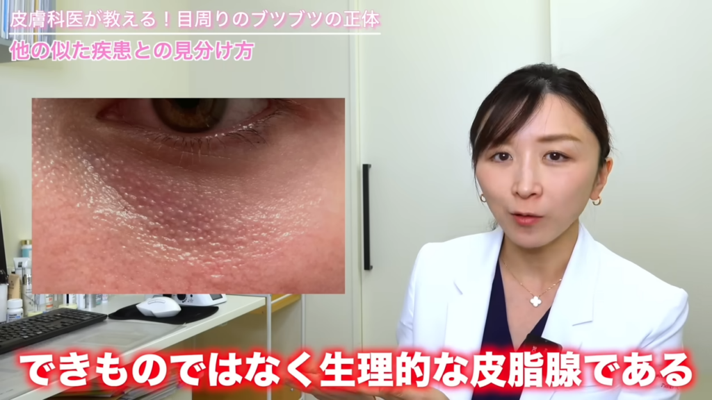 この目の下のブツブツというのは、できものではなく生理的な皮脂腺