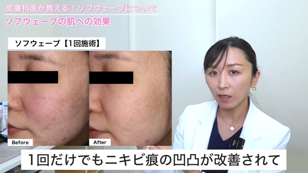 ソフウェーブ1回施術の写真