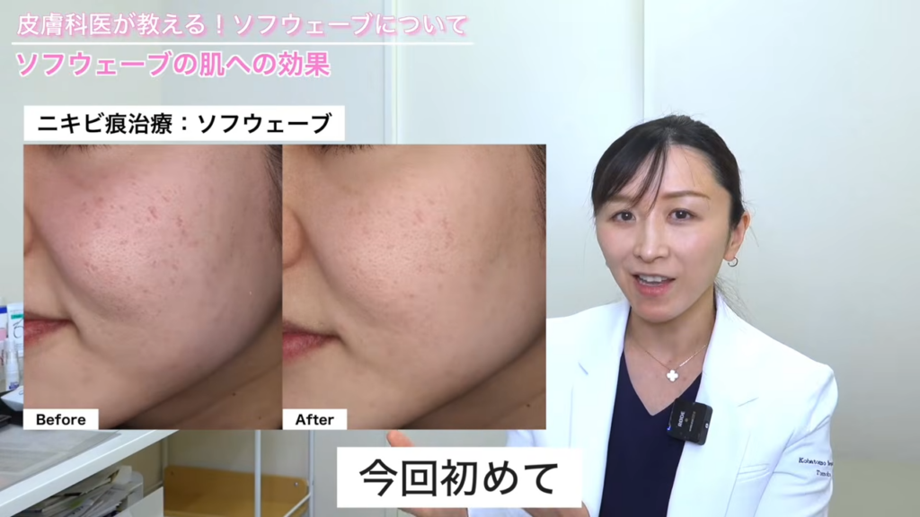ソフウェーブの症例写真