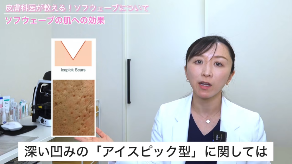 アイスピック型のニキビ跡