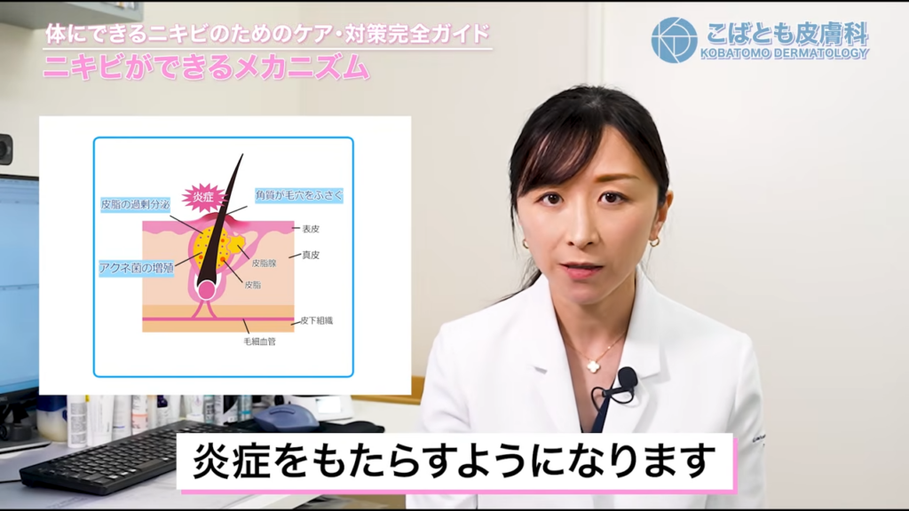 ニキビができるメカニズム