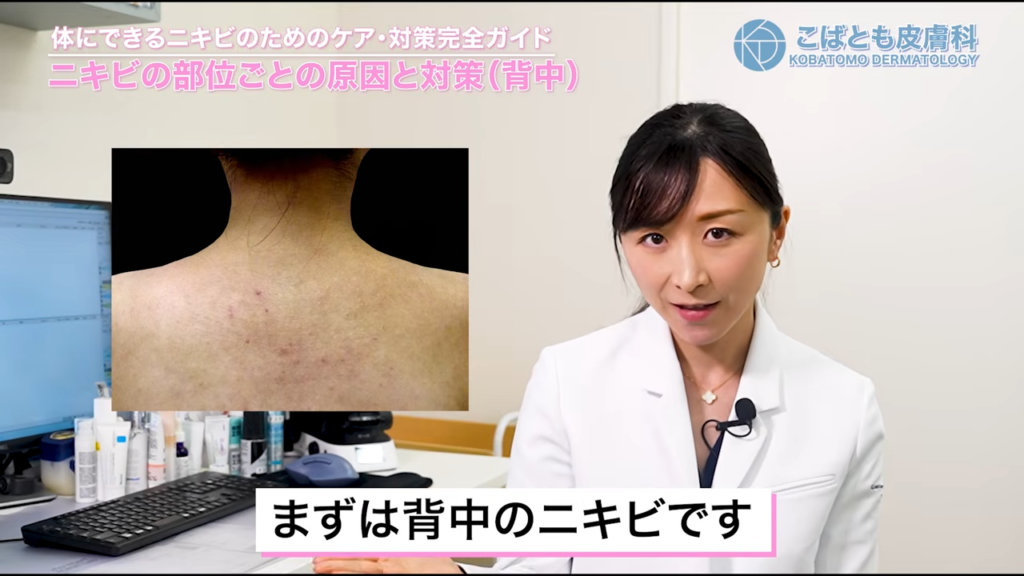 背中のニキビ