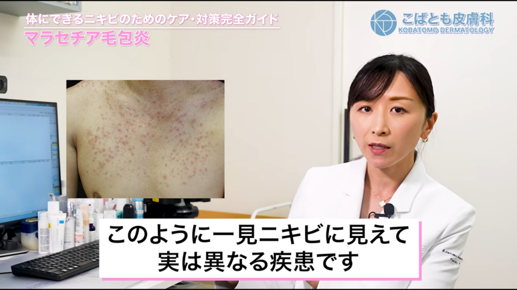 マラセチア毛包炎
