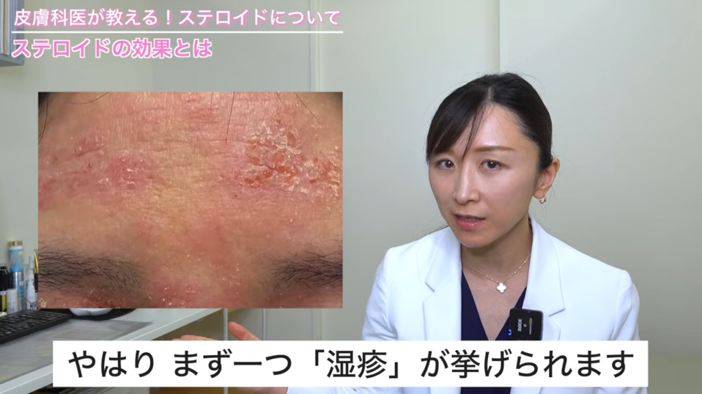 湿疹の症状写真
