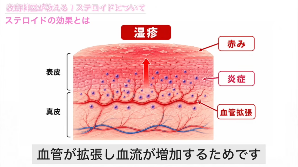 湿疹で赤みが起こる仕組み 解説図