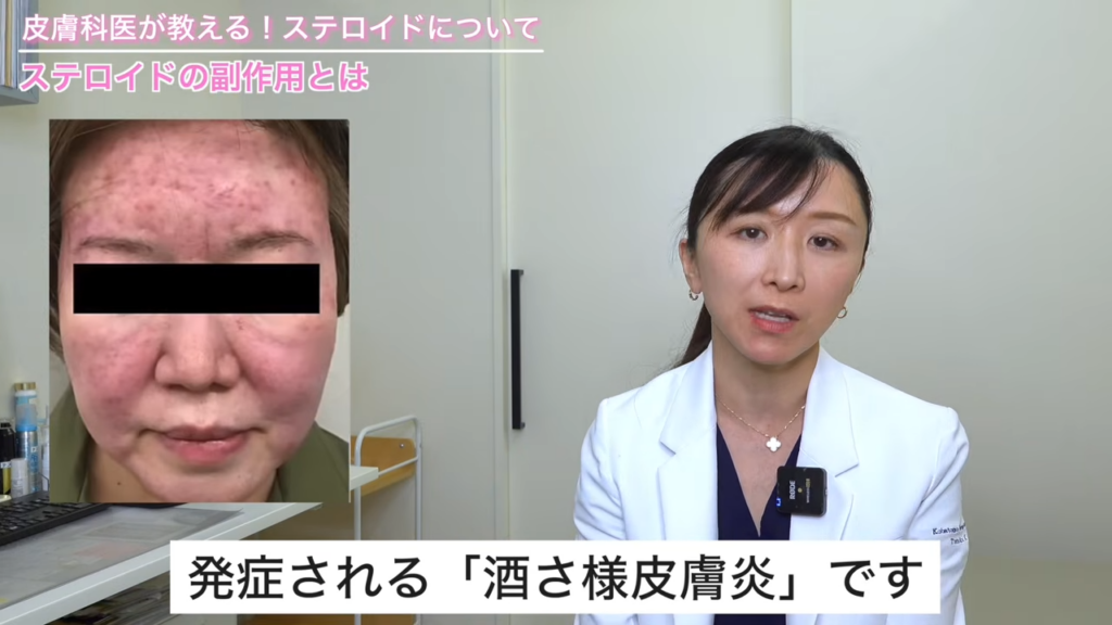 酒さ様皮膚炎 症状写真
