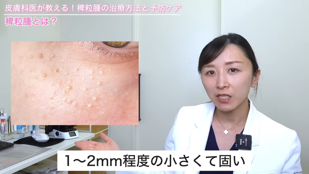 稗粒腫の症例写真