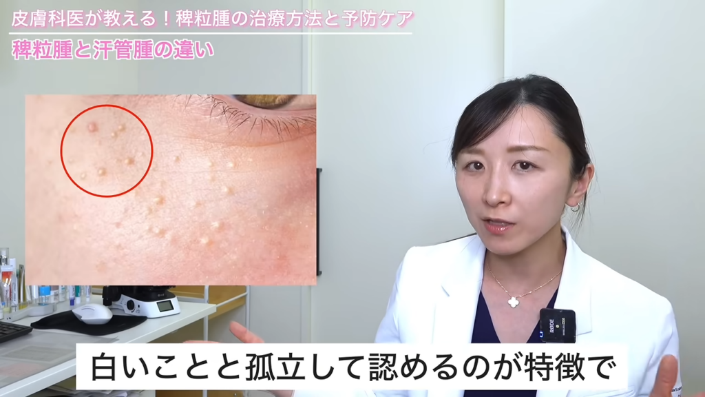 稗粒腫の特徴