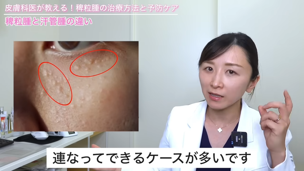 汗管腫の特徴