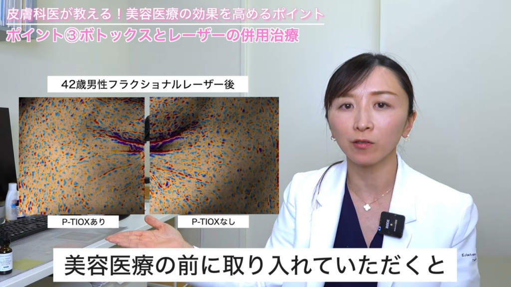 42歳男性フラクショナルレーザー後