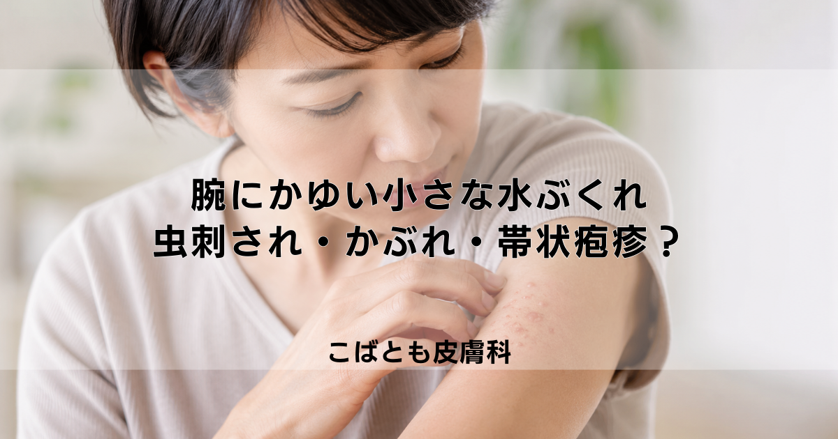 腕にできた、かゆい小さな水ぶくれの原因は？虫刺され・かぶれ・帯状疱疹かも